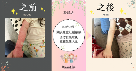 幼童嚴重濕疹痕癢紅腫 （聆肌方）