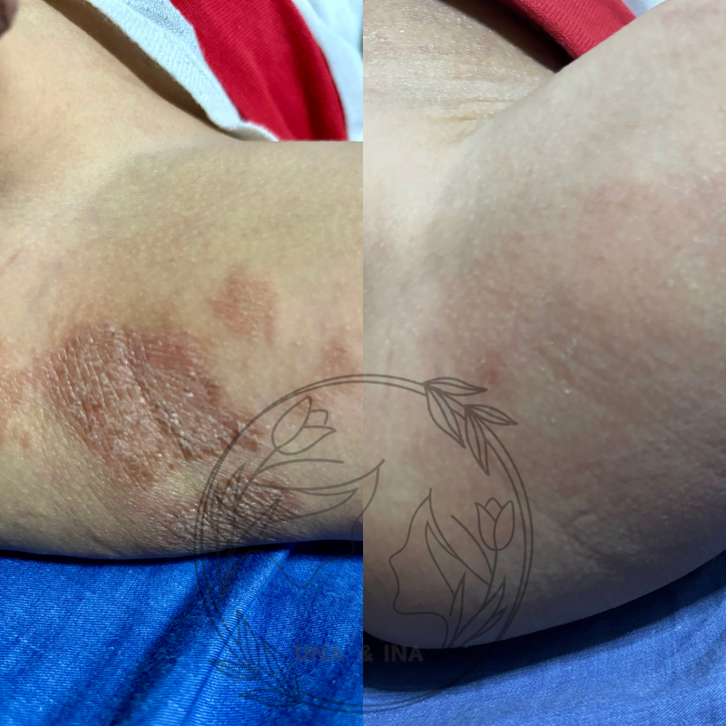 幼童濕疹(戒類固醇)