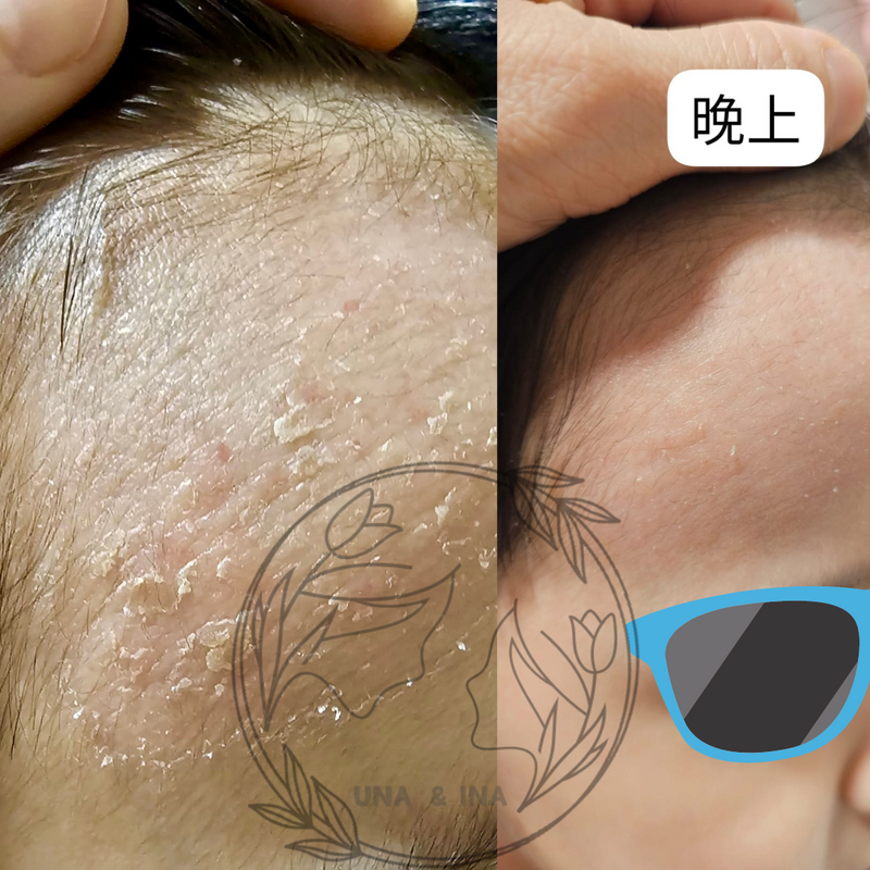 幼童濕疹(乾燥痕癢脫皮)