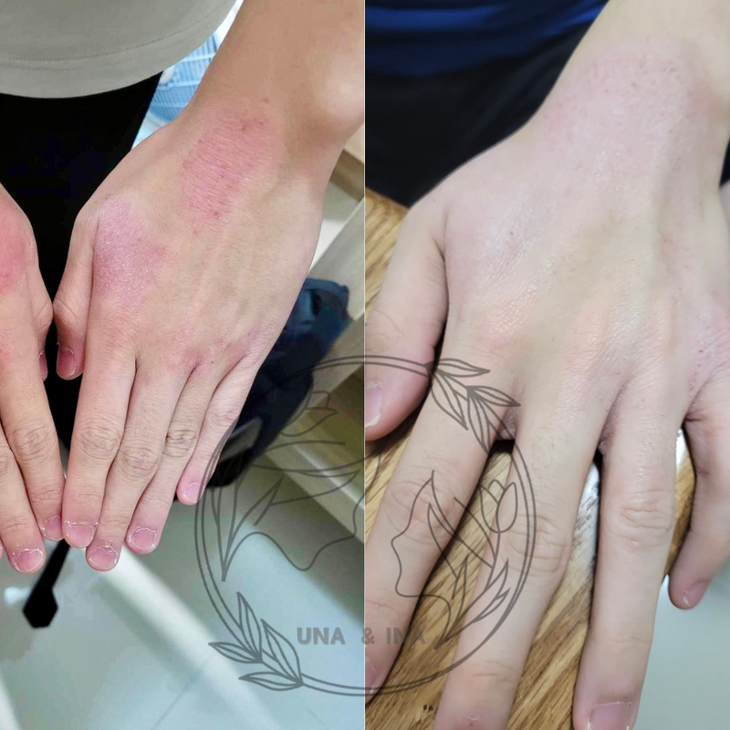 小女孩，手部長期乾燥泛紅