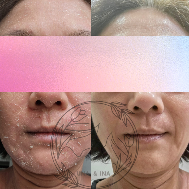 女士，濕疹（乾燥脫皮）