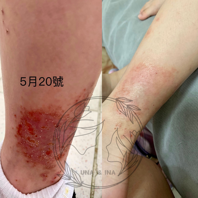 蚊蟲叮咬後嚴重敏感