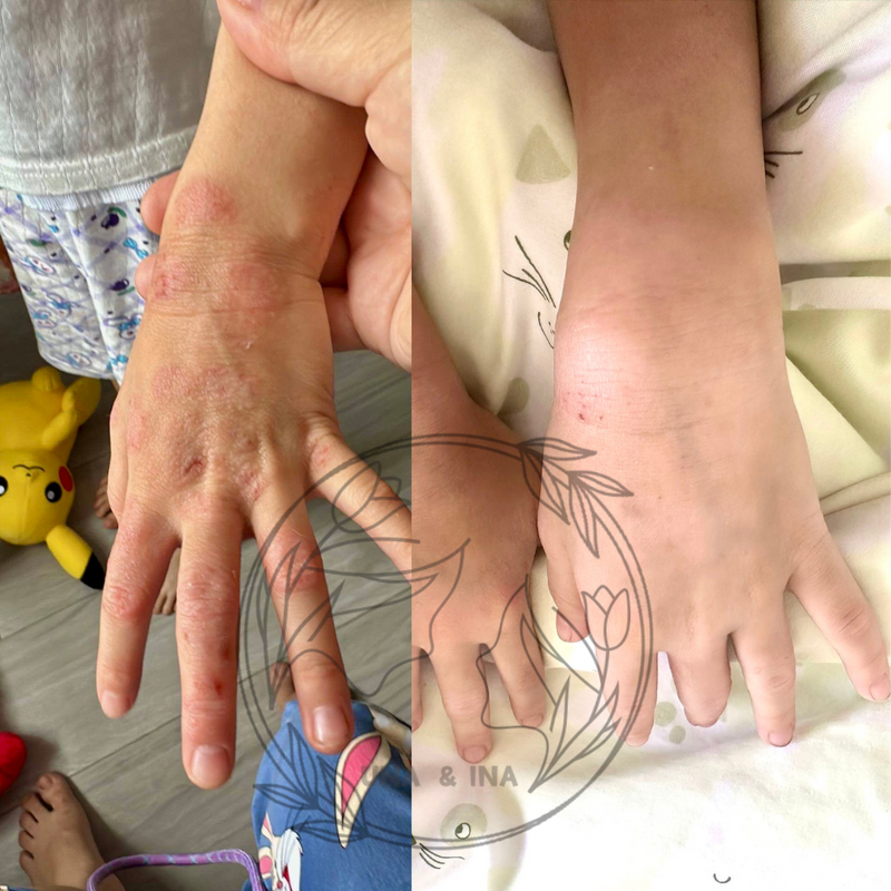 小女孩,濕疹(多年困擾)