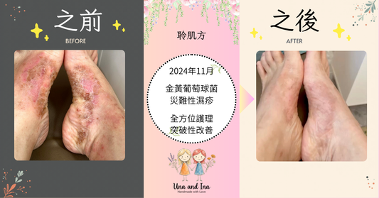 告別金黃葡萄球菌災難性濕疹：堅持帶來奇蹟