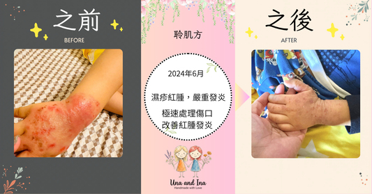 小童濕疹大爆發嚴重影響日常