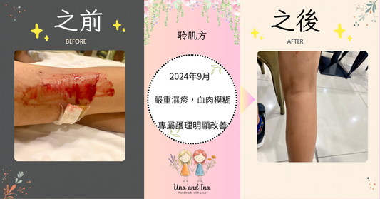 告別西藥依賴：重度濕疹根治，還孩子健康童年