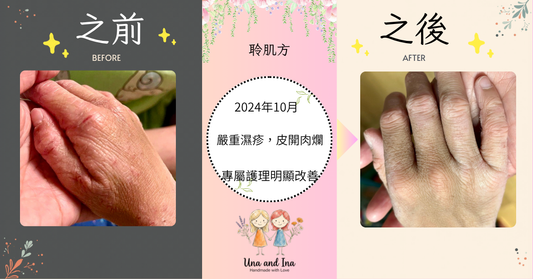 告別「皮開肉爛」的痛苦：小手重獲新生